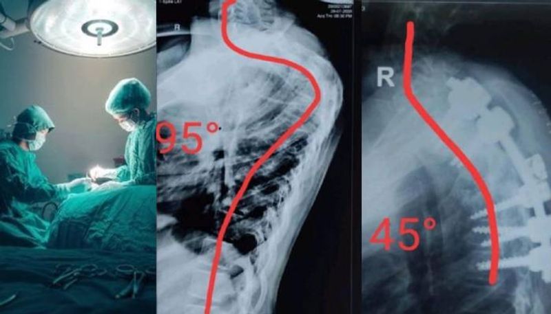 12 year old girl s curved spin rare surgery