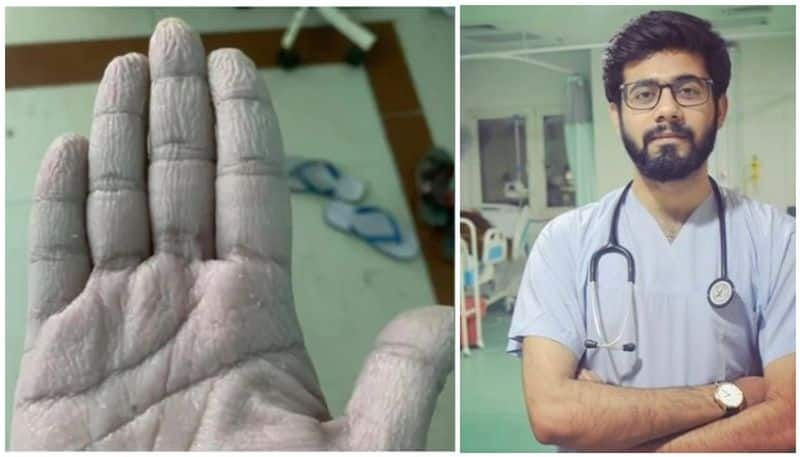 doctor posts photo of wrinkled hand after wearing ppe for hours in humid conditions