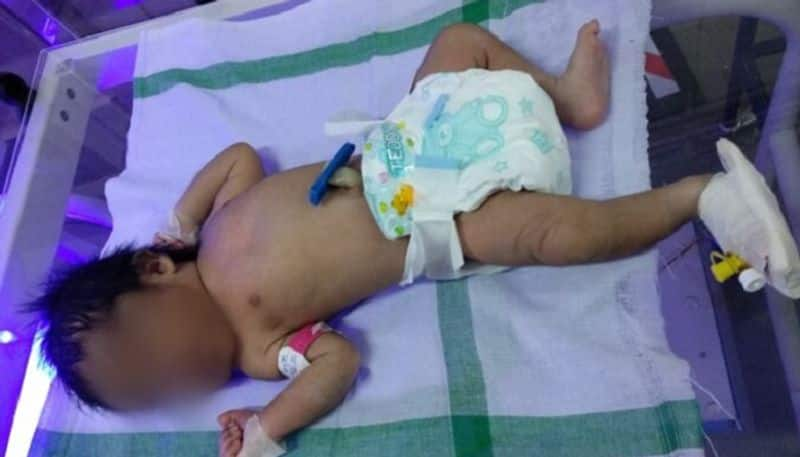 Baby Boy rescued By Shivamogga health Dept