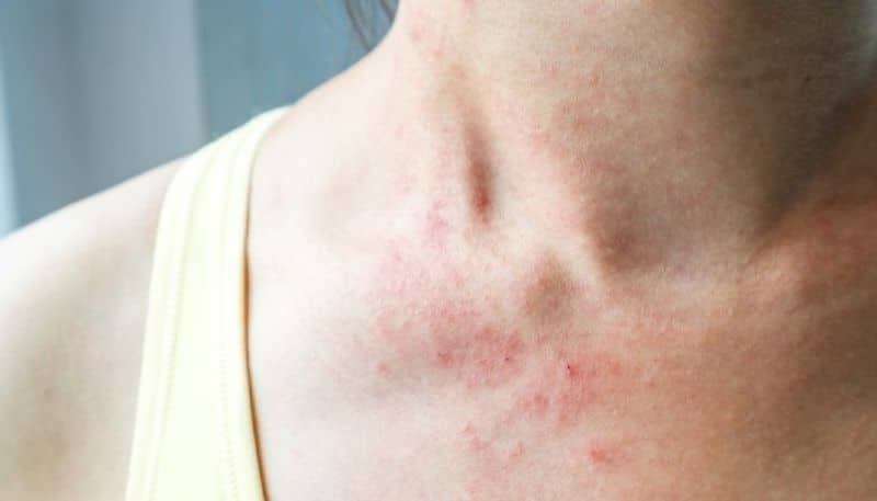 skin rashes may be a symptom of covid 19