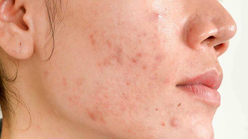 6 foods that can cure acne