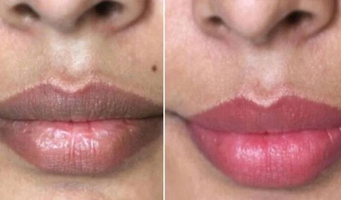 <p>Dark lips or dark spots on your lips can make you feel self-conscious and may also be a cause for concern. After all, a set of dazzling whites isn’t the only thing that makes for a beautiful smile, a pretty pout matters too.</p>
