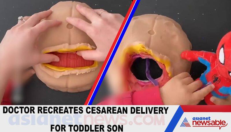 Doctor recreates Cesarean delivery for toddler son-tgy