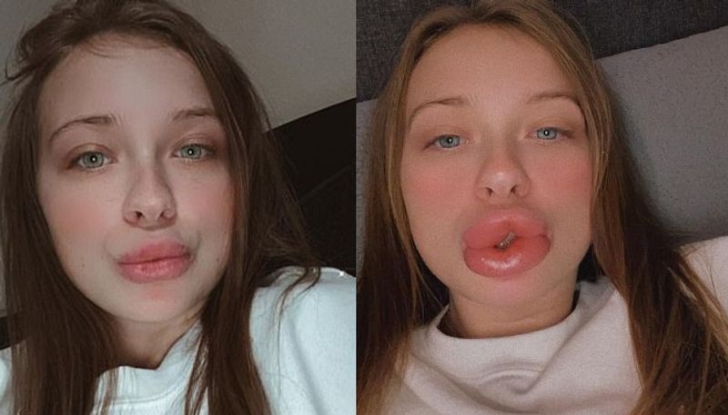 woman shares the horrific experience of filler treatment for lips