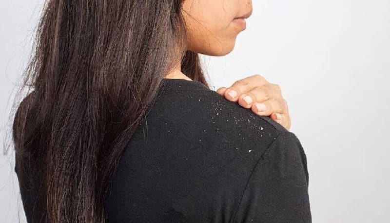 How to get rid of dandruff naturally