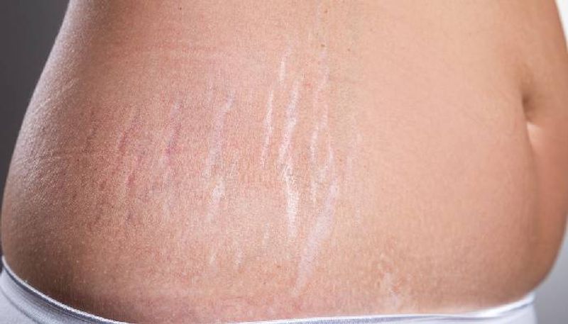 natural ways to get rid of stretch marks