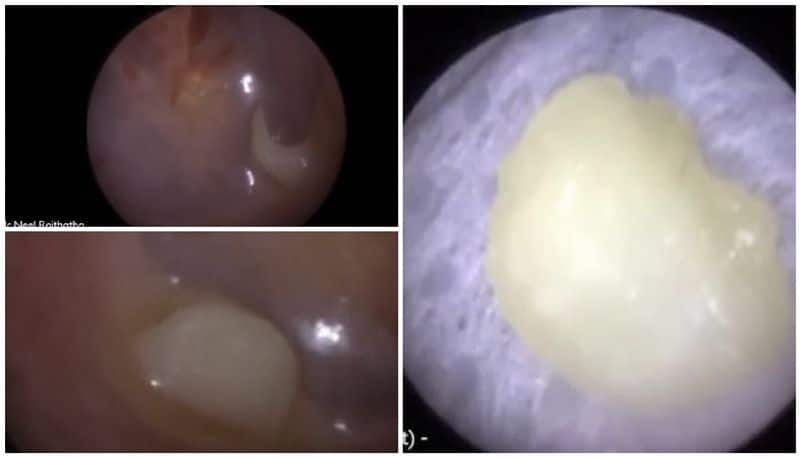 ear specialist has shared the moment he removes a baby tooth that is stuck to a three year olds eardrum