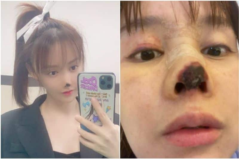 Chinese Star Gao Liu Shares Shocking Pics Of Botched Nose Surgery