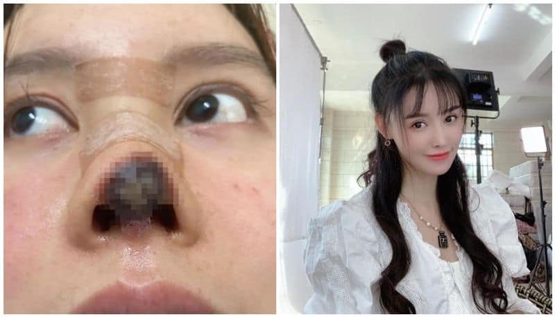 Chinese Star Gao Liu Shares Shocking Pics Of Botched Nose Surgery