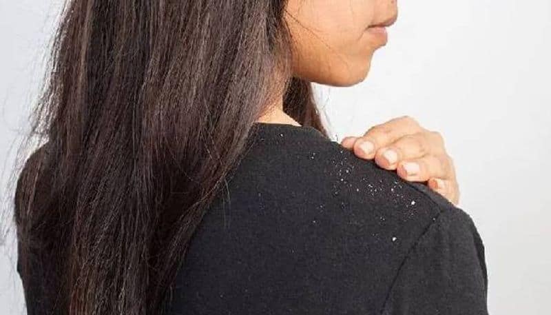 Prevent Dandruff and Hair loss with these small trick