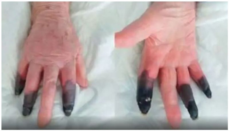 Italian Doctors Amputate 3 Fingers of Covid-19 Positive Woman After They Turn Black