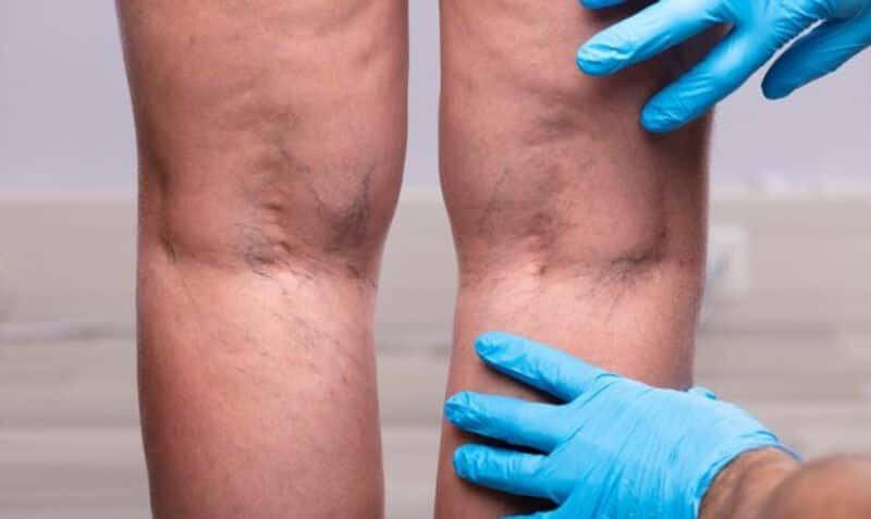 varicose veins causes symptoms and treatment in tamil mks