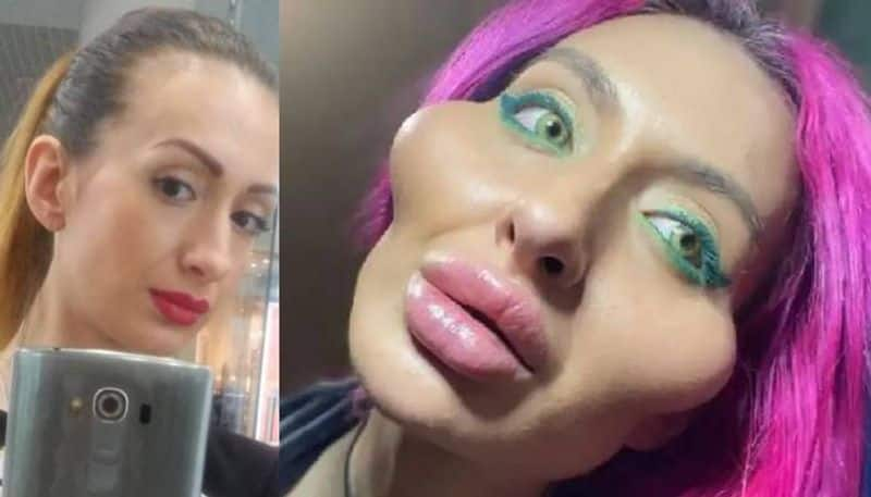 Model With Worlds Biggest Cheeks shared Pre Surgery Pics