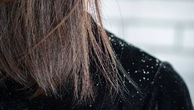 reasons behind dandruff and some solutions too