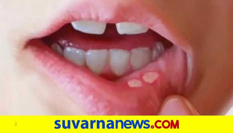 These are the home remedies for mouth ulcer