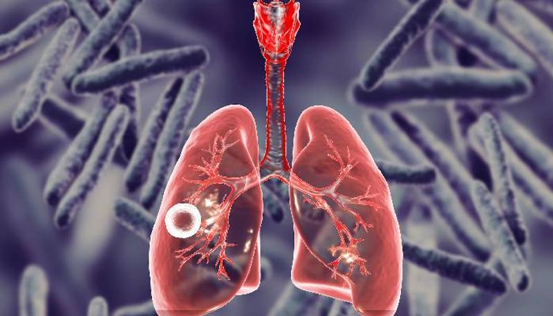 What is Tuberculosis (TB)? Know symptoms, treatment and how it spreads RBA