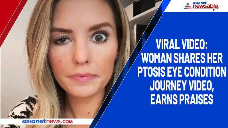 Viral video: Woman shares her ptosis eye condition journey video, earns praises-tgy