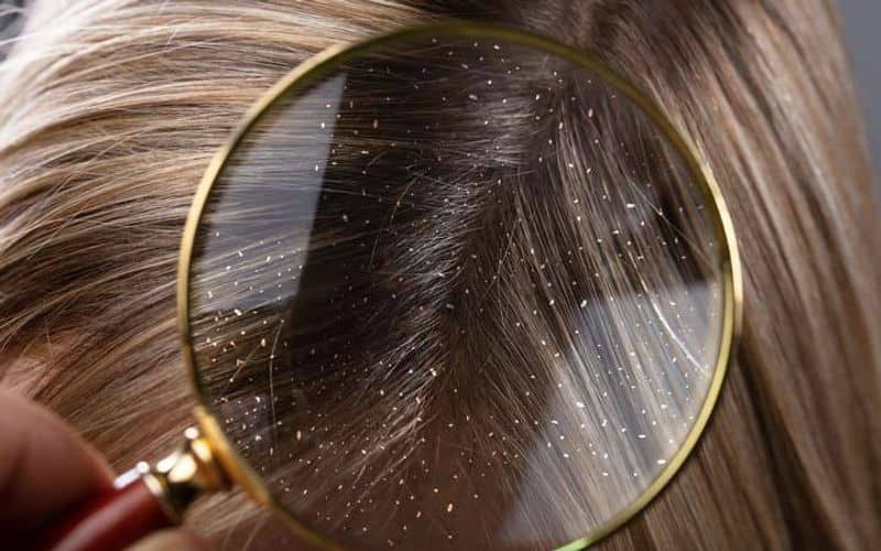 reasons behind dandruff and some solutions too