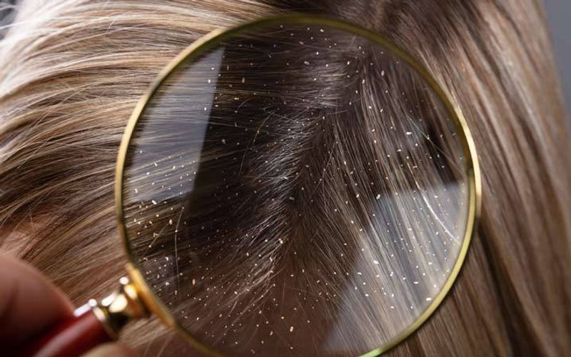 How to get rid of dandruff naturally