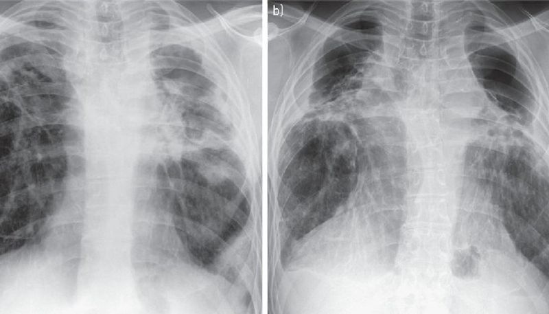 aspergillosis fungul cases are reporting in gujarat