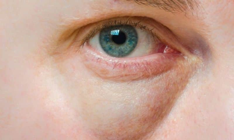 bags under eyes symptoms and causes