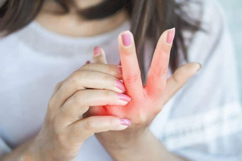 Skin care: Treat and cure eczema with these simple home remedies-dnm