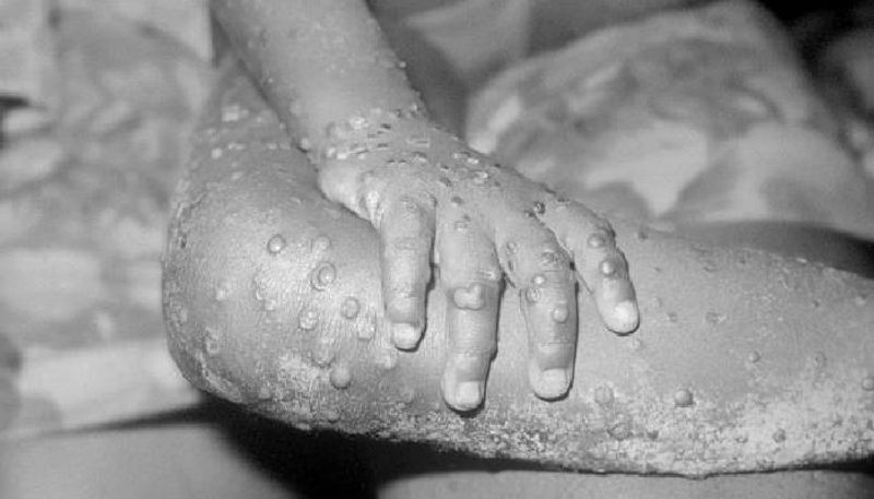 what are the monkeypox virus causes symptoms and precautions in tamil mks