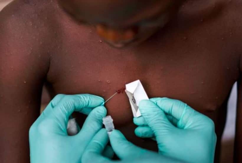 Monkey Pox is 'accelerating' fast, warn WHO officials: 10 points