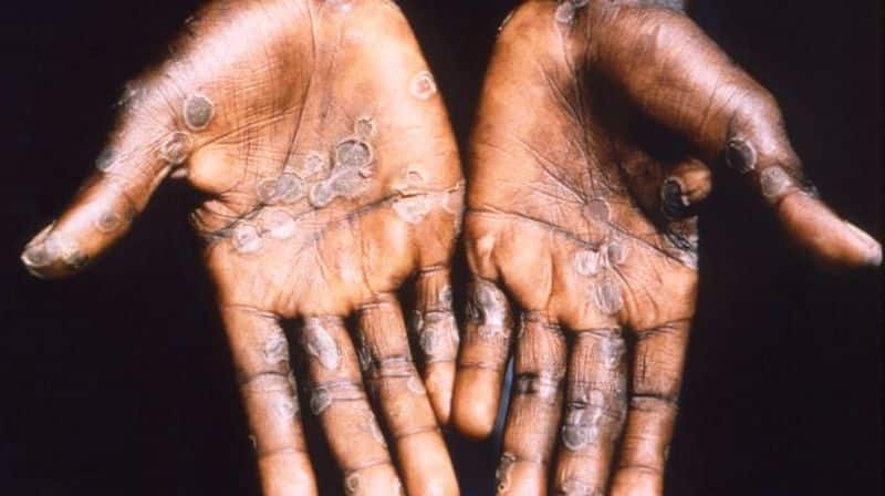 monkeypox : WHO confirms 80 cases in 11 countries