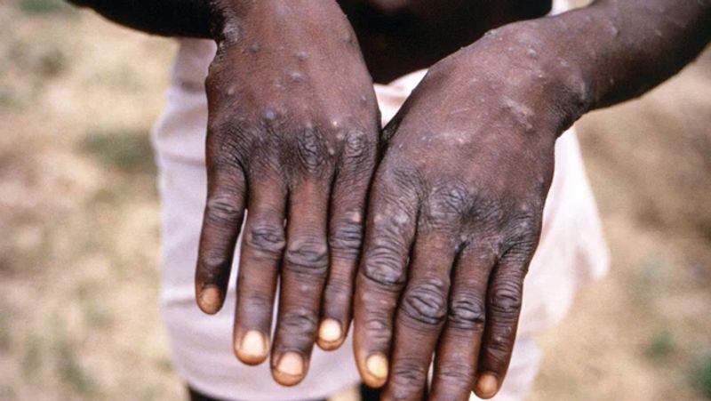 Monkeypox confirmed in Massachusetts; first US case identified in 2022 - adt 