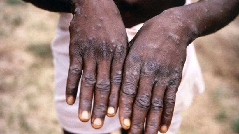 Monkeypox confirmed in Massachusetts; first US case identified in 2022