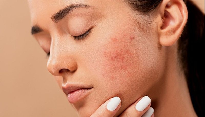 use these face packs to remove pimple marks