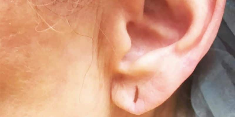 woman hospitalized after earlobes infected after lover tried sex through stretcher hole