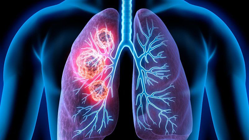 Lung cancer Symptoms and causes