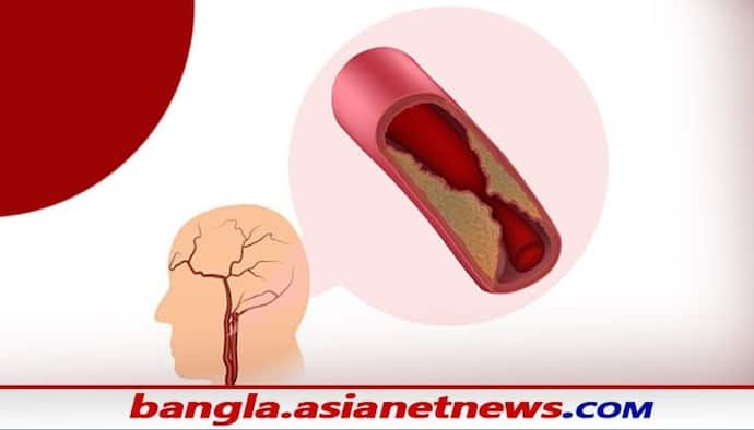 Health Tips: ক্যারোটিড আর্টারি ডিজিজে আক্রান্ত হচ্ছেন অনেকে, জেনে নিন এই রোগের ইতি বৃত্তান্ত