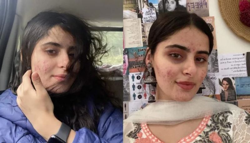 woman share bad experience on shaming for acne