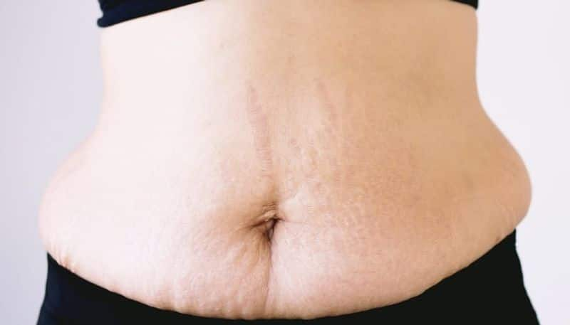 tips to get rid of stretch marks after delivery