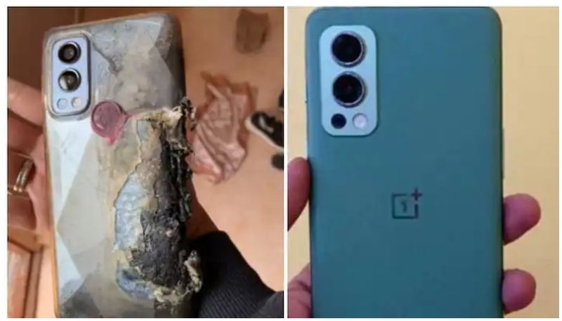 OnePlus Nord 2 5G Explosion: User Who Suffered Severe Burns Gets Refund, Medical Expenses