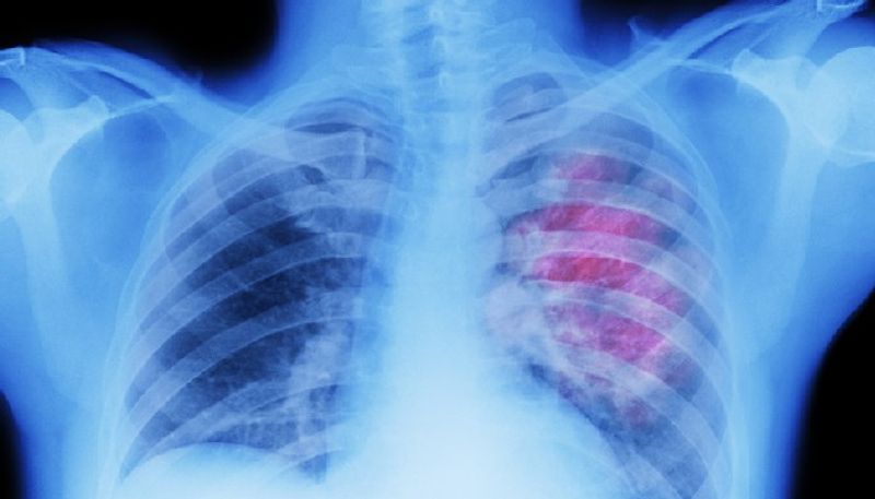 check oxygen level after covid recovery to know is the disease affected lungs