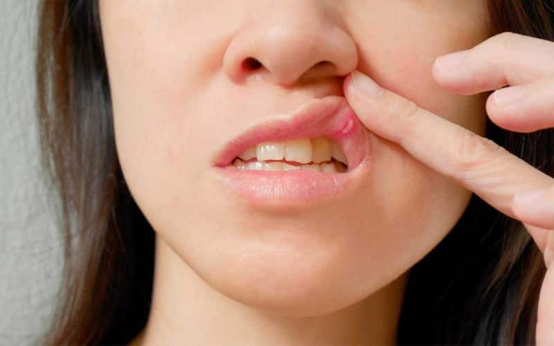 frequent mouth sores may also indicate malnutrition and immune deficiency