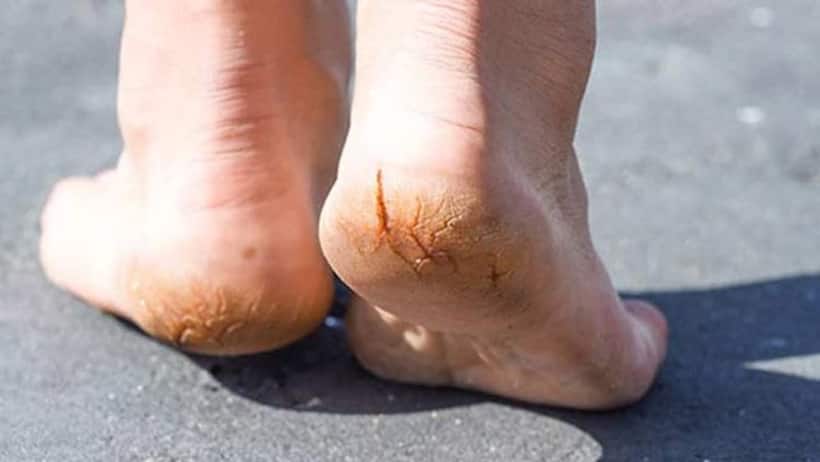 Cracked heels