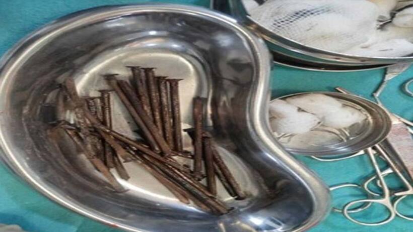 OMG: 17  के लड़के ने रोटी की तरह खा लीं 27 कीलें, डॉक्टर अल्ट्रासाउंड देख हैरान..बोले-ये अभी तक जिंदा कैसे?
