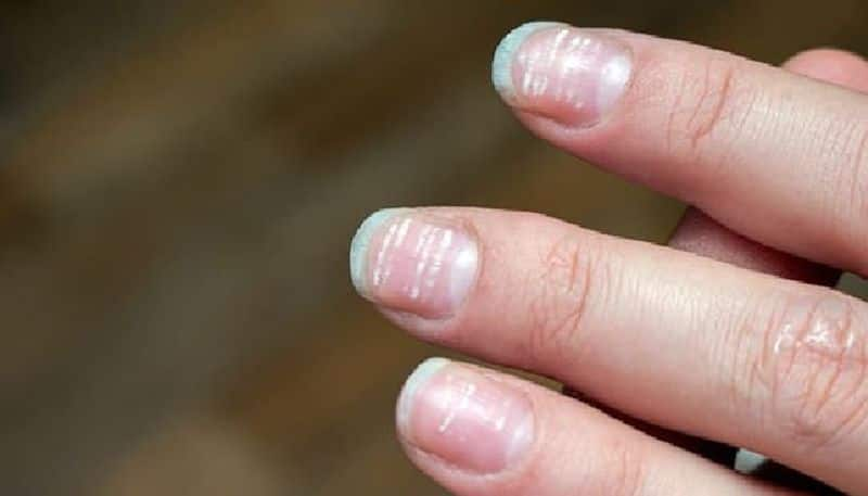 health tips why white spots appear on the nails know the causes full details here in tamil mks