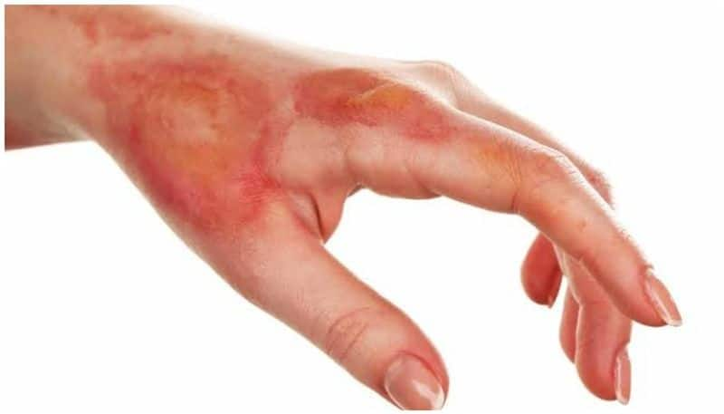 Karnataka Woman's  hand burnt as husband forces her take a fidelity test-dnm