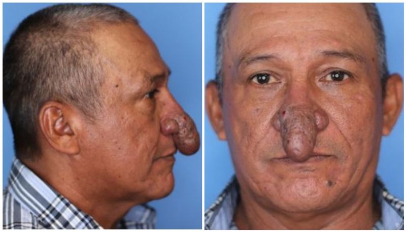 Man who spent years hiding penis shaped nose gets miracle surgery