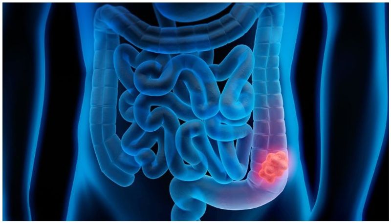 causes and symptoms of colorectal cancer