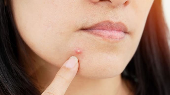 pimples