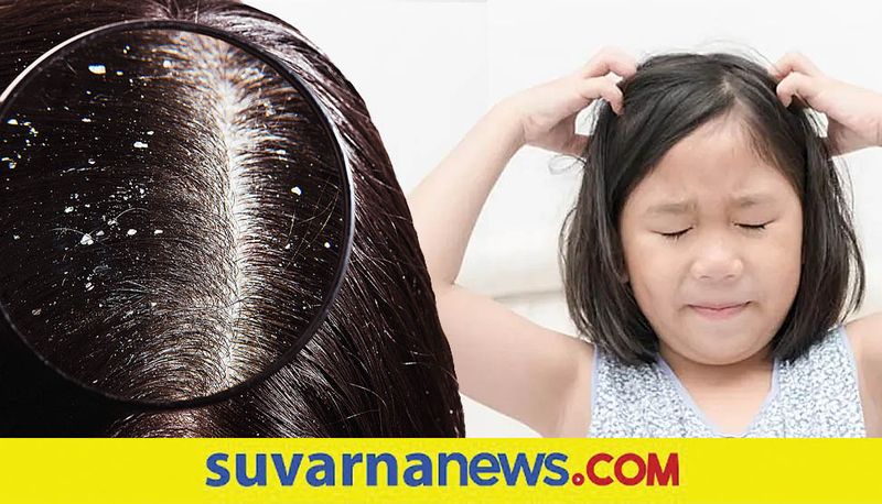 what to do about dandruff in children