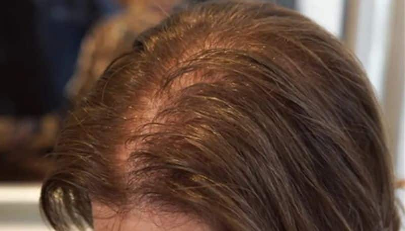 five hair care tips to treat hair thinning