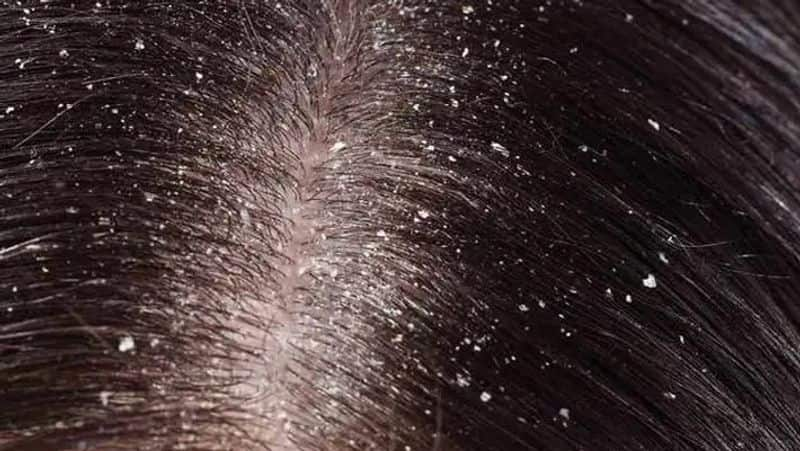 Home remedies to control Dandruff in Tamil, 